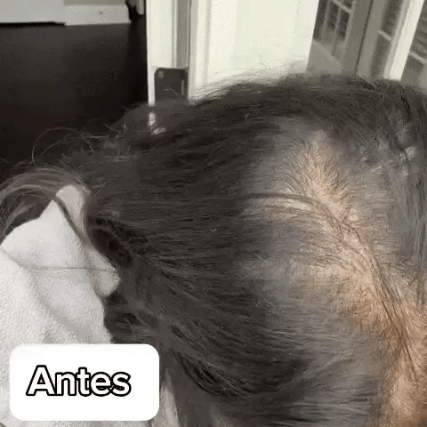 SERUM ANTICAIDA PARA CABELLO